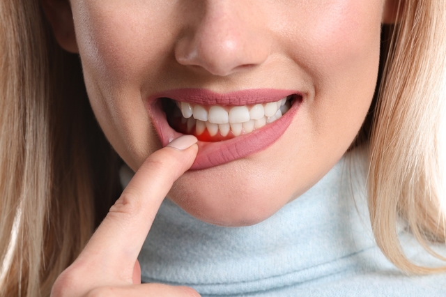 Nguyên nhân bị viêm lợi và cách điều trị