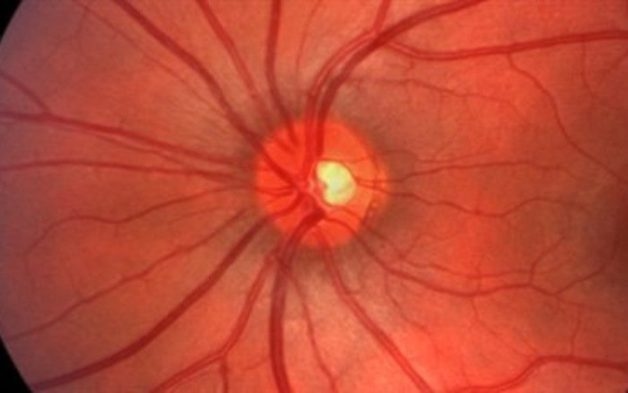 dấu hiệu viêm thị thần kinh