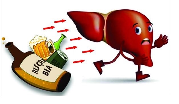 rượu bia là nguyên nhân xơ gan cổ trướng