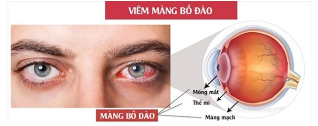 Viêm màng bồ đào là một trong những triệu chứng ngoài tiêu hóa xuất hiện ở người bệnh viêm đại tràng xuất huyết lâu năm