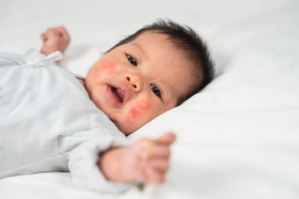 Chàm sữa là một trong những nguyên nhân khiến bé bị nổi mẩn đỏ quanh mắt