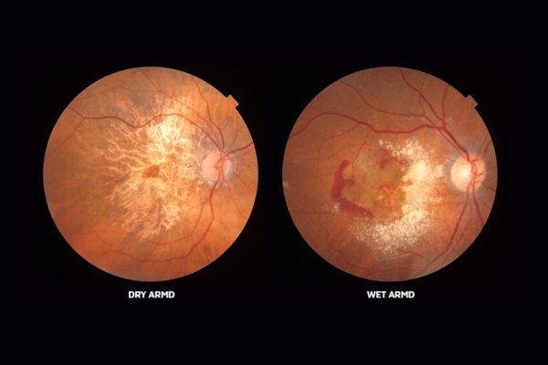 Thoái hoá điểm vàng do tuổi tác có thể là nguyên nhân gây phù hoàng điểm