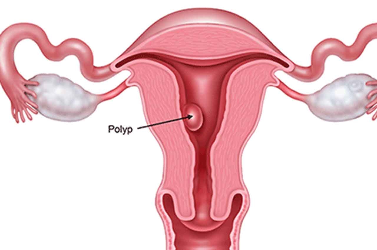 Chớ nên chủ quan với bệnh polyp tử cung ở phụ nữ