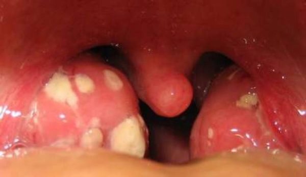 Viêm họng liên cầu khuẩn cần được điều trị sớm vì bệnh có thể dẫn đến các biến chứng nghiêm trọng 