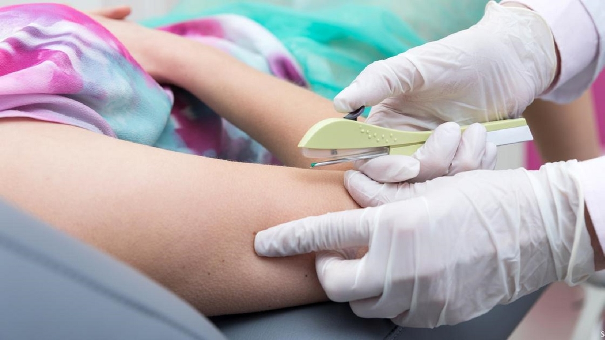Những điều cần biết về phương pháp cấy que tránh thai dưới da