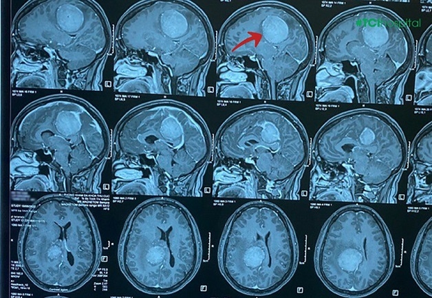 Đau đầu khó ngủ coi chừng u não