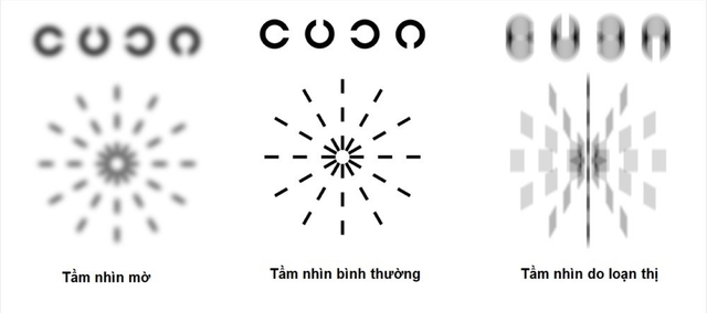 Những điều cần biết về loạn thị một mắt, loạn thị hai mắt