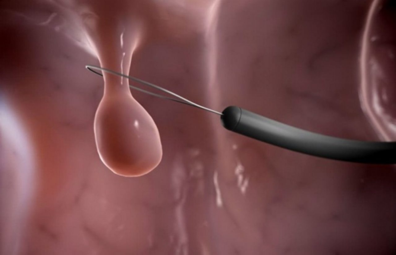 Là phụ nữ, chớ chủ quan với polyp tử cung