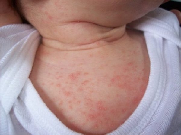 Trẻ em dễ bị nổi mẩn đỏ do da trẻ mỏng, dễ bị kích động bởi các tác nhân bên ngoài. 
