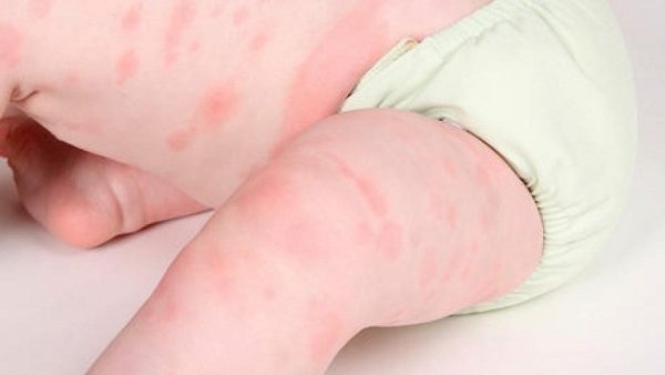 Tại sao trẻ bị nổi mẩn đỏ? Đó có thể là do con bị dị ứng với các tác nhân: thời tiết, thực phẩm, hóa chất, ...