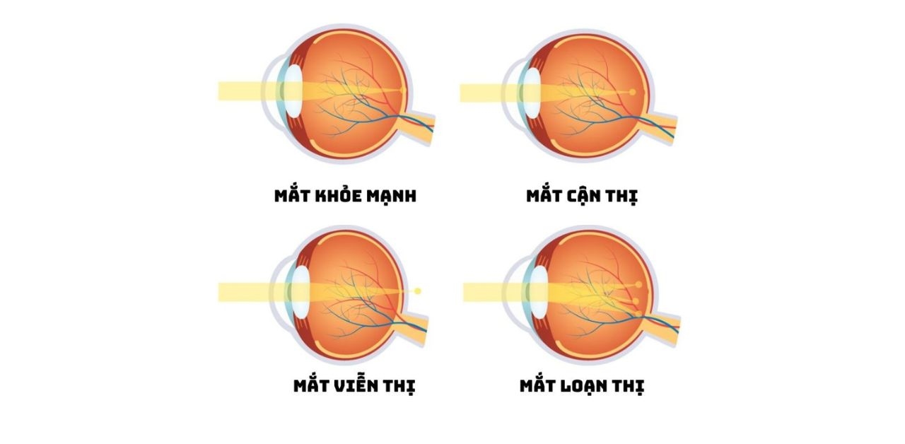 Các tật khúc xạ mắt ở trẻ em và cách phòng ngừa