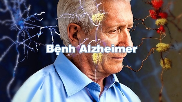 Bệnh Alzheimer được mệnh danh là kẻ đánh cắp ký ức trải qua 4 giai đoạn. 