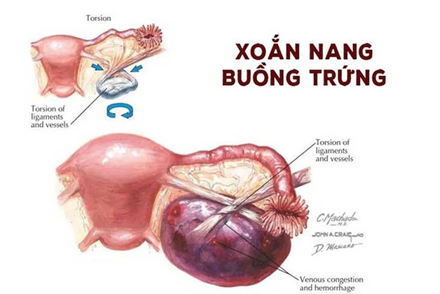 U nang buồng trứng xoắn là biến chứng nguy hiểm, tiềm ẩn nhiều vấn đề ảnh hưởng đến chức năng, hoạt động của buồng trứng
