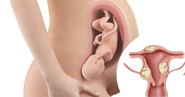 Phụ nữ bị u xơ tử cung có mang thai được không?