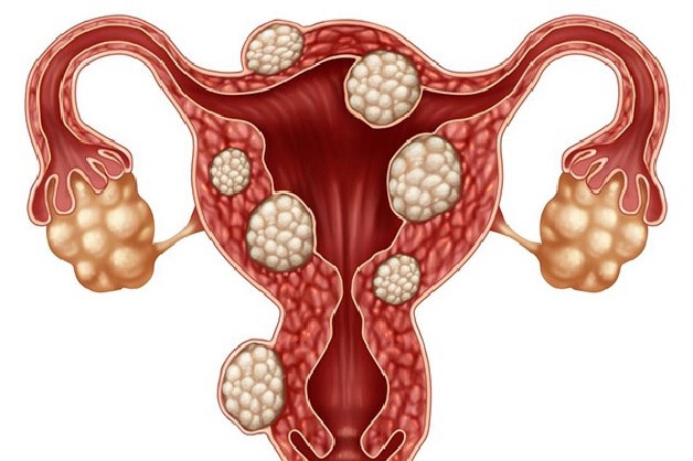 U xơ tử cung đa nhân là tình trạng khối u phát triển với nhiều nhân xơ có đường kính khác nhau
