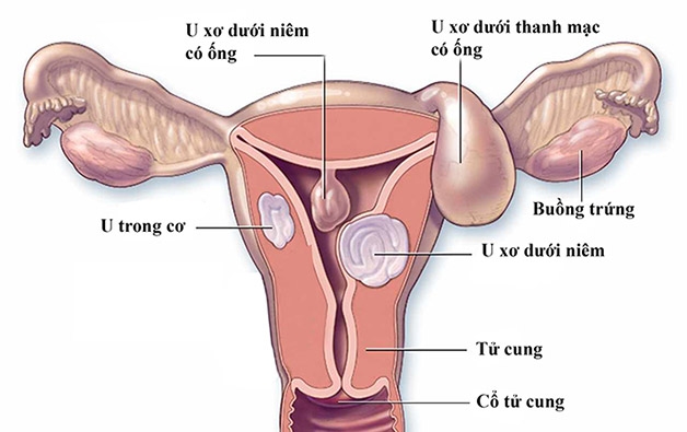 U xơ tử cung thoái hóa có thể được hiểu đơn giản là tình trạng khối u xơ không tiếp tục phát triển nhưng cũng không được loại bỏ