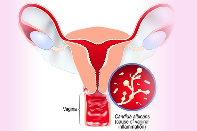 Viêm nấm phụ khoa, liệu phụ nữ có cần cảnh giác?