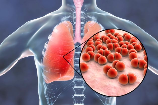 Khái niệm bệnh viêm phổi trẻ em