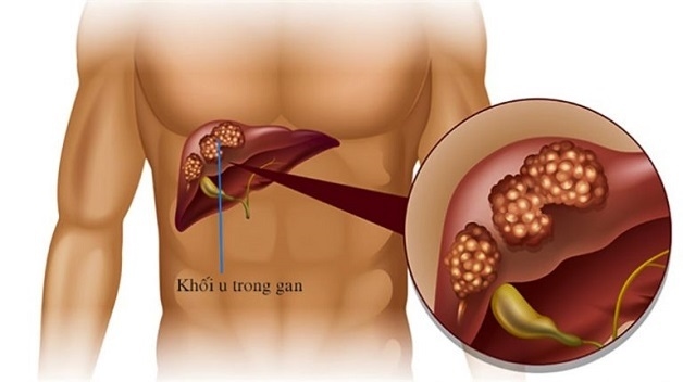 Xơ gan giai đoạn mất bù