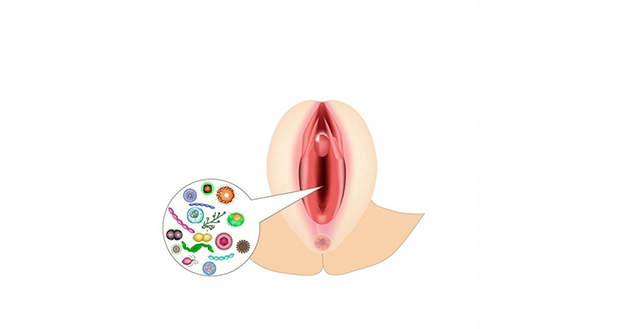Âm đạo viêm do nhiều tác nhân và có thể diễn biến ngày càng nghiêm trọng hơn