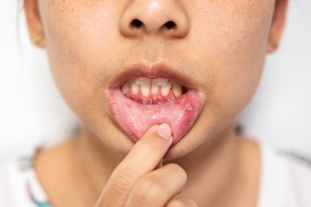 Dấu hiệu cho thấy bé bị viêm loét niêm mạc miệng. 