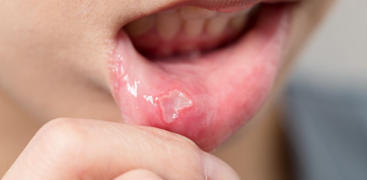 Bé bị viêm loét niêm mạc miệng phải làm sao?