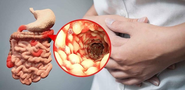 Nguyên nhân bệnh viêm ruột non