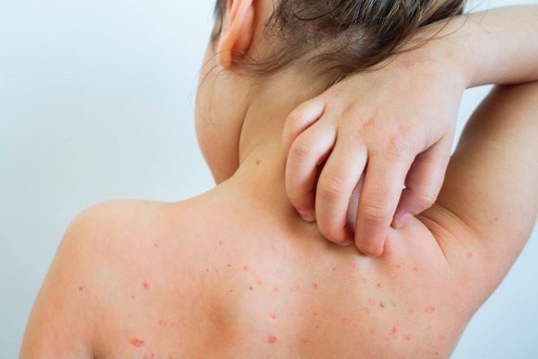 Trẻ mắc thủy đậu sẽ xuất hiện mụn nước khắp toàn thân