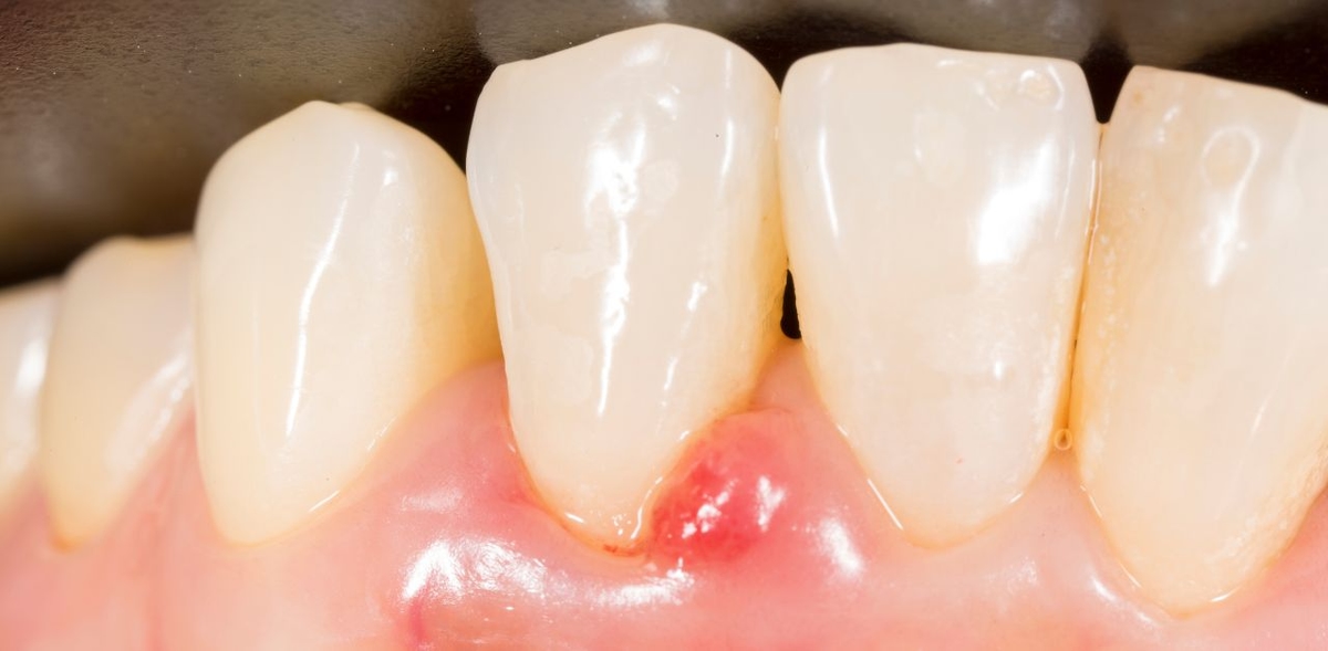 Chân răng bị sưng mủ là bệnh gì?