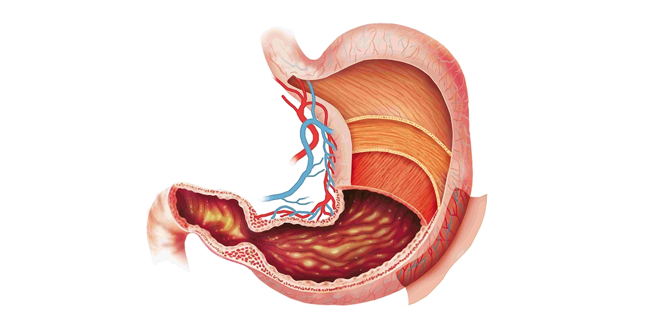 Dấu hiệu viêm dạ dày cấp: Nhận biết sớm &#8211; điều trị hiệu quả