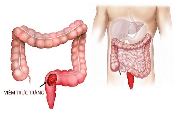Đau trực tràng cũng có thể do viêm trực tràng