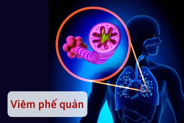 Cách điều trị viêm phế quản cấp và những điểm cần lưu ý