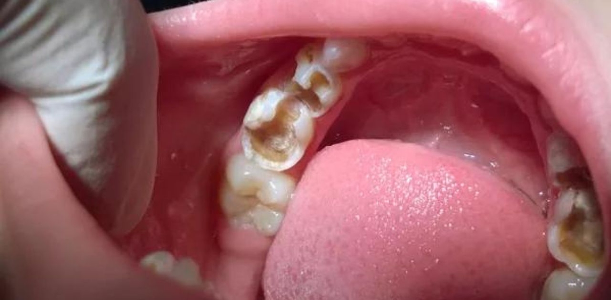 Hàn răng trẻ em dưới 4 tuổi có được không?