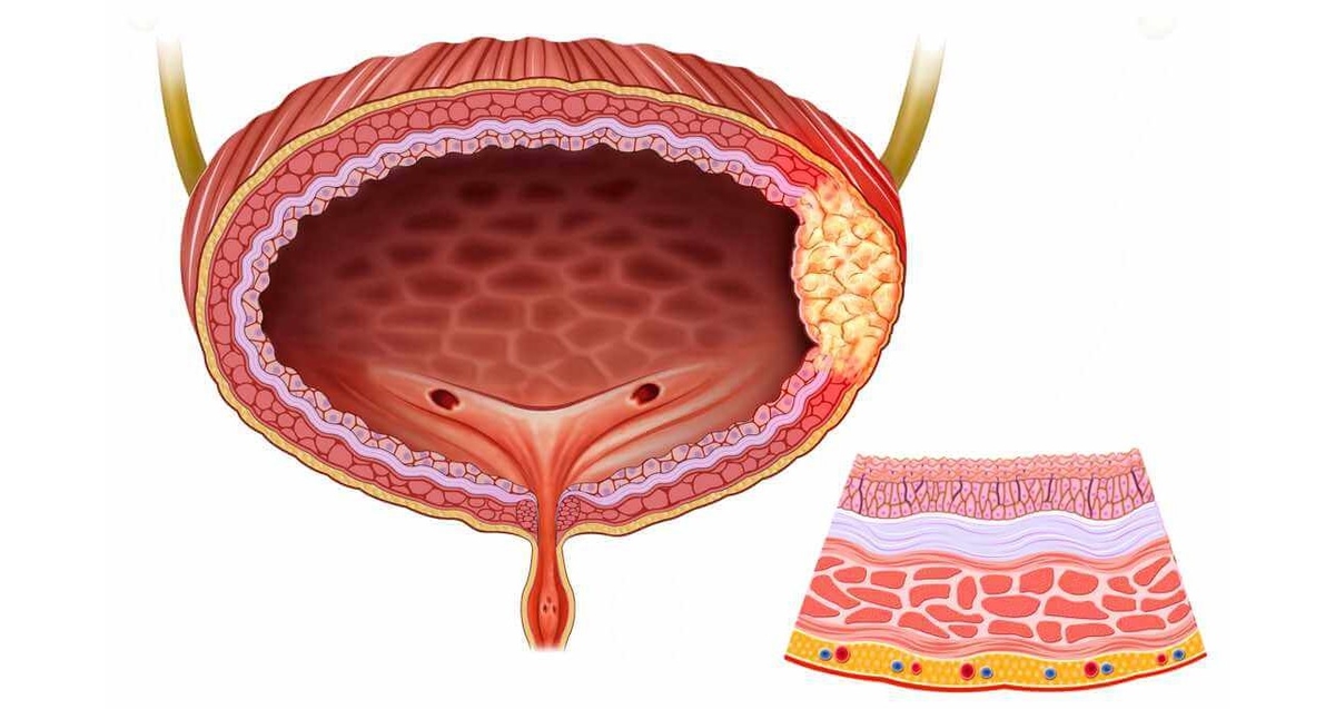 Tìm hiểu về hóa chất điều trị ung thư bàng quang