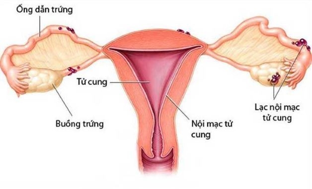 bệnh lý lạc nội mạc tử cung sau mổ đẻ