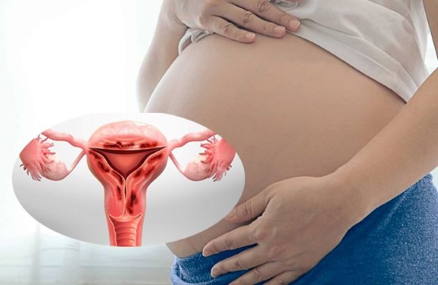 Lạc nội mạc tử cung khi mang thai có thể khiến mẹ gặp nhiều triệu chứng khó chịu trong thai kỳ