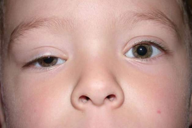 mí mắt bị sụp