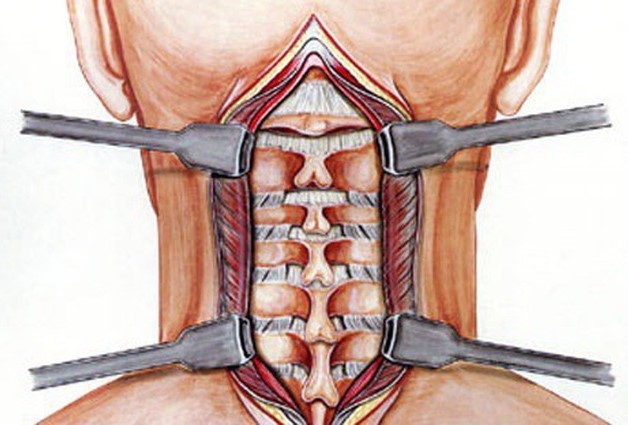 Vôi đốt sống cổ thường xảy ra ở 3 đốt C4-C5 và C6