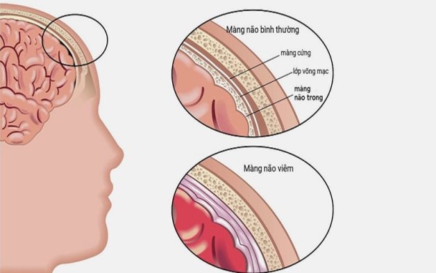 Viêm não là biến chứng nguy hiểm nhất của quai bị