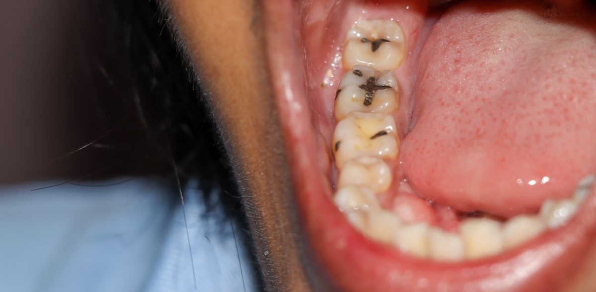 Phải làm sao khi răng số 7 bị sâu vỡ?