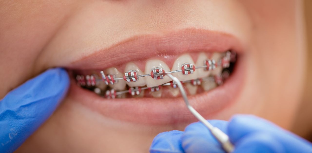 Cảnh giác sâu răng khi niềng răng