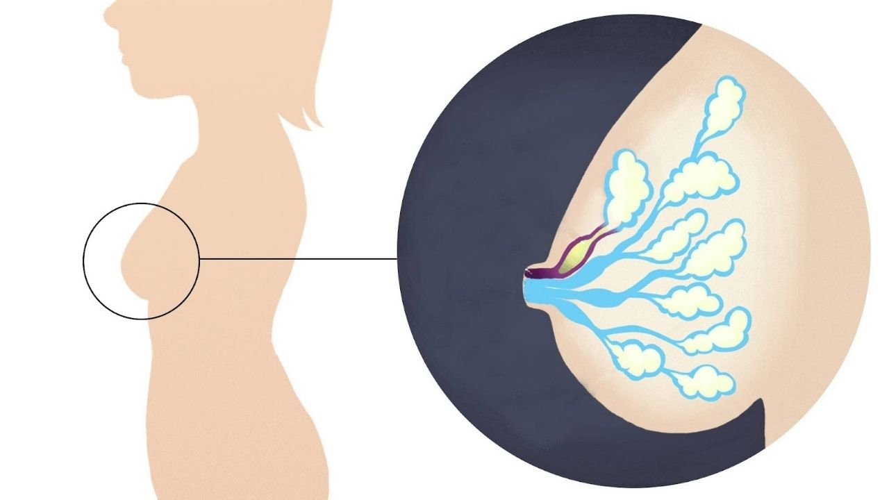 Tắc tia sữa là tình trạng hệ thống ống dẫn sữa bị tắc, do đó sữa không thể chảy ra ngoài được