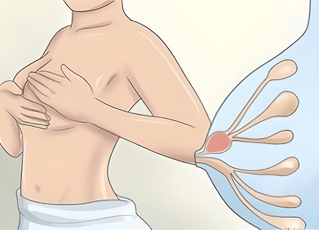 Tắc tia sữa là tình trạng sữa mẹ bị tắc bên trong ống dẫn sữa mà không thể chảy ra ngoài