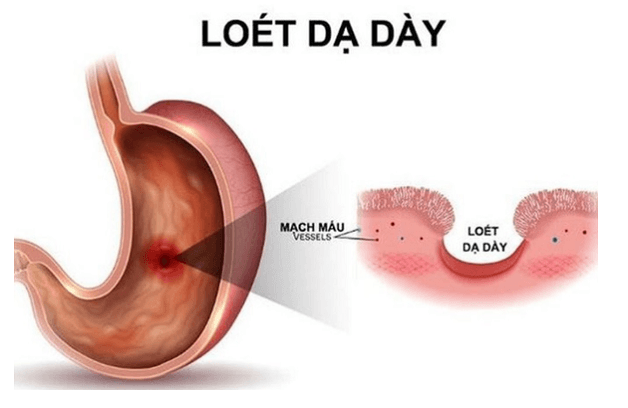 cách nhận biết viêm loét dạ dày và điều trị
