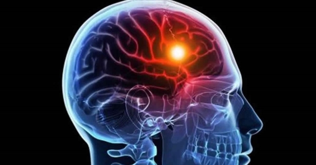 Bệnh alzheimer ở người trẻ tuổi có phải do di truyền?