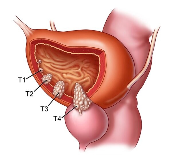 Tìm hiểu phương pháp hóa trị ung thư bàng quang