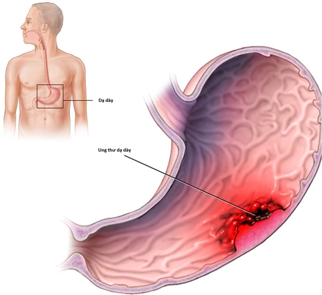 Giải đáp các thắc mắc về hóa trị liệu ung thư dạ dày