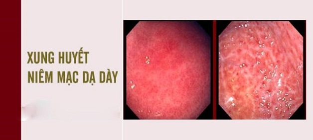 Viêm loét dạ dày có mấy cấp độ? Bệnh được chia thành 4 cấp độ
