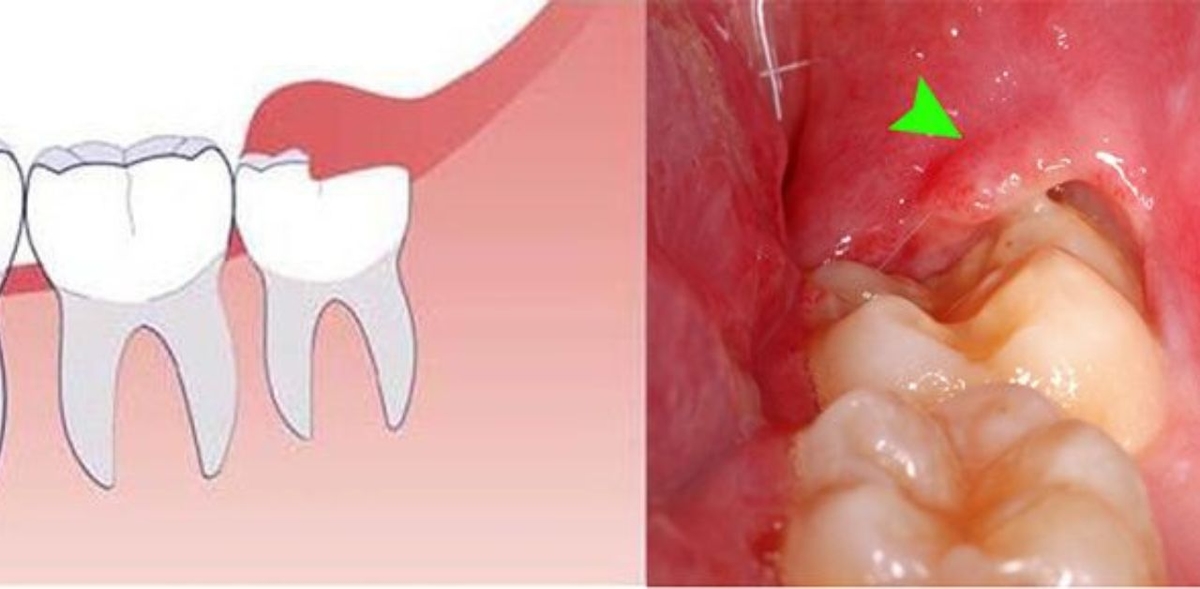 Dấu hiệu viêm lợi trùm chân răng không thể bỏ qua