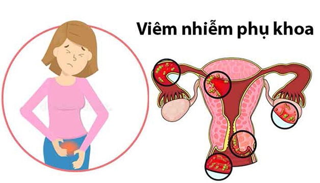 Viêm nhiễm phụ khoa là chỉ tình trạng viêm, tổn thương tại một số cơ quan sinh dục như âm hộ, âm đạo, tử cung, cổ tử cung, buồng trứng, vòi trứng,...